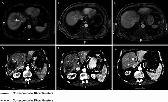 Contrast-enhanced magnetic resonance (MR) images of an 82-year-old patient with advanced HCC (a) at diagnosis (b) at 6-month follow-up after using cannabis oil (c) at 6 years after diagnosis. Contrast-enhanced computed tomography (CT) images of a 77-year-old patient with advanced HCC (d) at diagnosis (e) at 6-month follow-up after using cannabis oil (f) at almost 4 years follow-up after using cannabis oil. N necrosis, t tumor