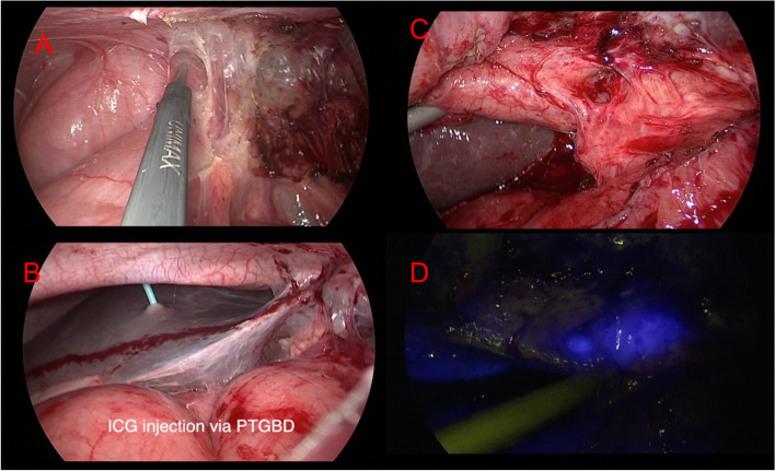 Fluorescent and white light imaging of biliary tree before hilum dissection. A Grade IV adhesion due to previous gastric surgery. B The ICG was injected via percutaneous transhepatic gallbladder drainage (PTGBD). C Identification recording of the biliary tree using white light imaging: CD (-), CBD (-). D Fluorescent enhancement recording of the biliary tree via NIR imaging CD ( +), CBD ( +)