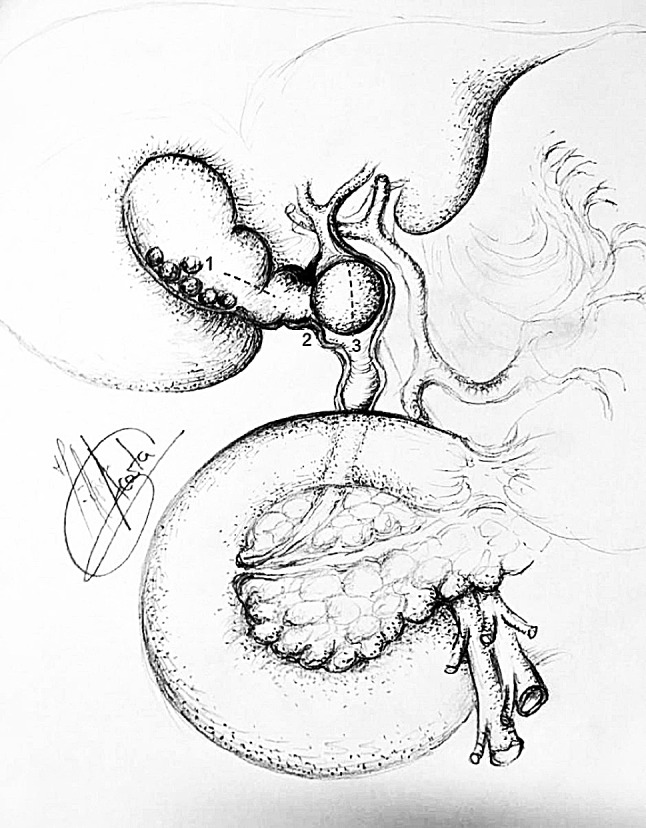 Incisions to access CBD in Mirizzi syndrome