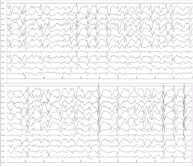 Interictal electroencephalogram during sleep showing quasi-continuous, centro-temporal, and high voltage spike-and-wave complexes, frequently followed by theta-delta activity.