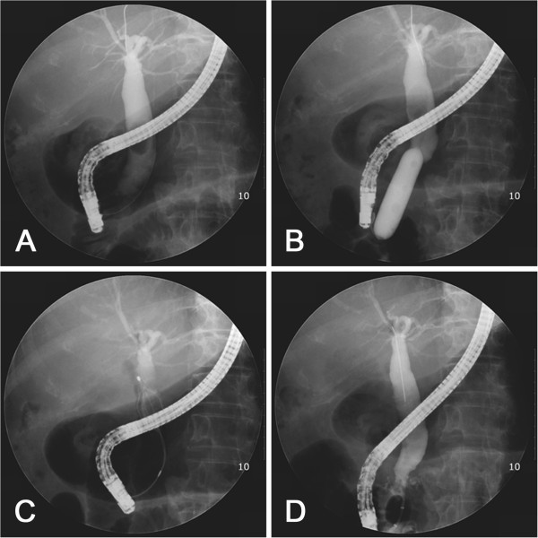 Fluoroscopic view of large-balloon dilatation without biliary sphincterotomy. A. Cholangiogram demonstrating a large stone within the dilated bile duct. B. Large balloon inflated across over guidewire. The diameter of the balloon was selected according to the diameter of the stone and of the bile duct proximal to the tapered segment under fluoroscopic guidance. C. The stone was captured in a basket. D. Cholangiogram after complete stone removal showed no residual filling defect in the bile duct.