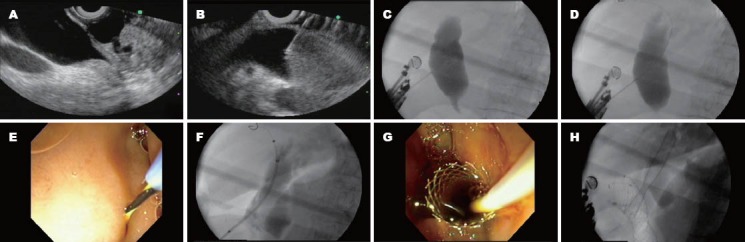 Sequence of images demonstrating the steps of the choledochoduodenostomy. The last image shows the final appearance of simultaneously biliary and duodenal metal stents.