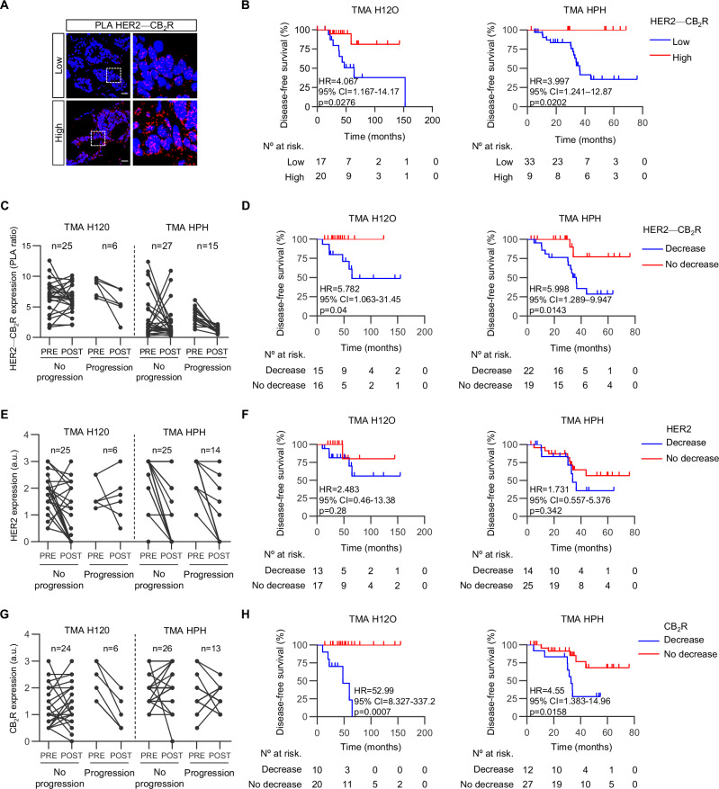 A reduction in HER2-CB2R and CB2R expression after NAT is linked to treatment resistance.A Representative Proximity Ligation Assay (PLA) images of human samples exhibiting high and low HER2-CB2R heteromer expression. Red: PLA signal; blue: nuclear staining (DAPI). Scale bar, 25 μm. B Kaplan-Meier plots of disease-free survival for samples obtained after NAT and included in the tissue microarrays from Hospitals 12 de Octubre (TMA H12O) and Puerta de Hierro (TMA HPH). C Relative HER2-CB2R expression, as determined by PLA, in matched TMA samples. The left data columns in each panel represent samples from patients with no long-term disease progression, while the right columns represent the non-responders. Lines connect paired samples from the same patient before (PRE) and after (POST) NAT. D Kaplan-Meier plots of disease-free survival, stratified by type of change in HER2-CB2R dimer expression after NAT, in samples from the indicated TMAs. HER2 (E) and CB2R (G) expression, as determined by IHC, in samples from TMA H12O and TMA HPH, represented as indicated in panel (C). Kaplan-Meier plots of disease-free survival, stratified by changes in HER2 (F) or CB2R expression (H) after NAT, in samples from the indicated TMAs.