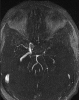 MRA showing marked reduction in the caliber of the left internal carotid artery, with occlusion of the left middle and anterior cerebral artery
