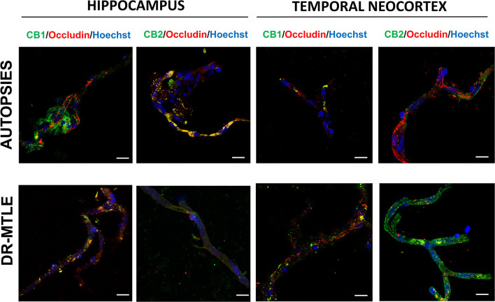 Double-labeling immunofluorescence staining of occludin and CB1 or CB2 in MECs isolated from the hippocampus and temporal neocortex of non-epileptic autopsies and patients with DR-MTLE. Cell nuclei were stained with Hoechst (in blue). Notice the low occludin staining colocalization with low (hippocampus) and high (temporal neocortex) CB1 and CB2 staining in MECs of patients with DR-MTLE. All scale bars are 20 μm.