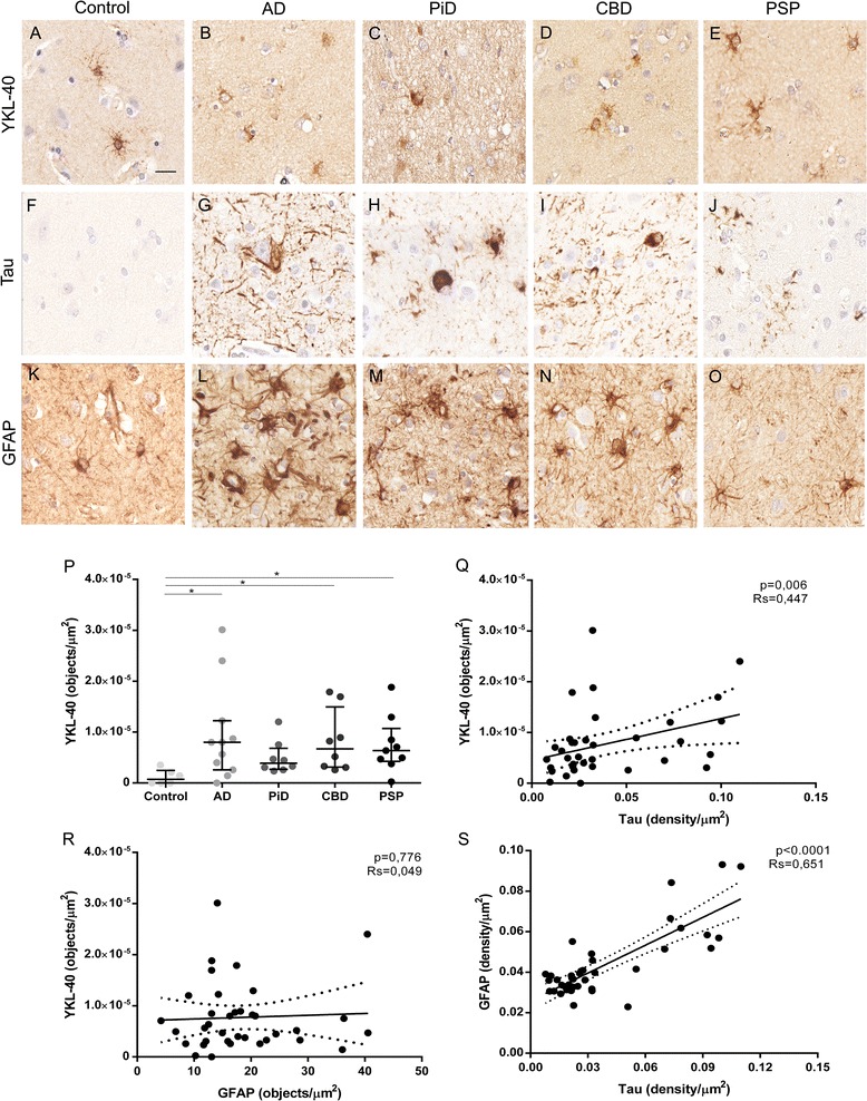 Quantification of YKL-40, tau pathology burden and astrogliosis in different tauopathies. a–o Representative images of YKL-40, tau and GFAP immunoreactivity of controls and the four tauopathies under study. a–e YKL-40 expression pattern. f–j Main tau deposits and aggregates of each condition. k–o Astrogliosis among the tauopathies and controls. Scale bar = 20 μm. p YKL-40 immunoreactivity (objects/μm2) measured in all conditions. q–s Correlation between different markers. Levels of YKL-40 and GFAP correlated positively with tau aggregation. Solid lines indicate the linear regression, and dotted lines indicate 95% CI. RS, Spearman rho coefficient.