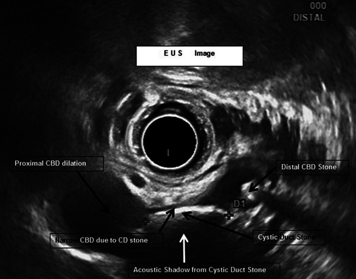 EUS image showing type 1 Mirizzi syndrome.