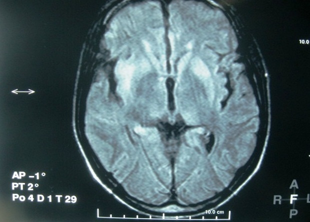 Brain MRI showing bilateral and symmetric hyperintensity of striatum and hyperintensity of the right insular cortex on FLAIR image
