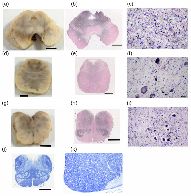 Macroscopic, semi‐macroscopic, and microscopic findings of the midbrain, pons, and medulla oblongata. Depigmentation is apparent in the substantia nigra (a). Threads are abundant in the midbrain tegmentum as well as the substantia nigra (b). Neuronal loss with threads is observed in the substantia nigra (c). The locus coeruleus shows mild depigmentation (d) with some threads and neurofibrillary tangles (f). Numerous threads are present in the pontine tegmentum and fibers of the pontine base (e). The tegmentum of the medulla oblongata shows brownish degenerative changes (g), where threads are also abundant (h). The olivary nuclei contain many threads and some neurofibrillary tangles (h, i). The pyramidal tract at the level of the medulla oblongata does not show degeneration (j, k). Gallyas‐Braak silver staining (b, c, e, f, h, i) and Klüver‐Barrera staining (j, k). Scale bars: 500 μm (a,b, d, e, g, h, j), 25 μm (c, f, i), 250 μm (k).