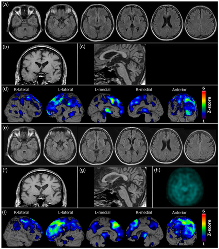 Neuroradiological findings. (a) Magnetic resonance fluid‐attenuated inversion recovery imaging (MRI FLAIR) (patient age: 51 years) showing slight atrophy of the left frontal lobe. In addition, mild asymmetric atrophy can be observed in the frontal operculum. (b, c) T1‐weighted MRI (patient age: 51 years) showing no atrophy of the amygdala or midbrain. (d) Brain perfusion single‐photon emission computed tomography (SPECT) easy Z‐score imaging system (eZIS) analysis (PDRadiopharma Inc.) (patient age: 51 years) showing hypoperfusion in the left‐dominant frontal lobe and mild parietal lobe. The color scale for the Z score is shown in the right part of the figure. Colored areas indicate a Z score >1. (e) MRI FLAIR images (patient age: 52 years) showing mild enlargement of the left Sylvian fissure, in addition to left frontal lobe atrophy. (f, g) T1‐weighted MRI (patient age: 52 years) showing no atrophy of the amygdala and midbrain. (h) 123I‐N‐omega‐fluoropropyl‐2‐beta‐carbomethoxy‐3‐beta‐(4‐iodophenyl) nortropane SPECT (patient age: 53 years) depicting a marked reduction in dopamine transporter (DAT) availability in the whole striatum bilaterally on visual assessment. (i) Brain perfusion SPECT eZIS analysis (PDRadiopharma Inc.) (patient age: 52 years) showing worsening of hypoperfusion in the left frontal lobe. The color scale for the Z score is shown in the right part of the figure. Colored areas indicate a Z score >1.
