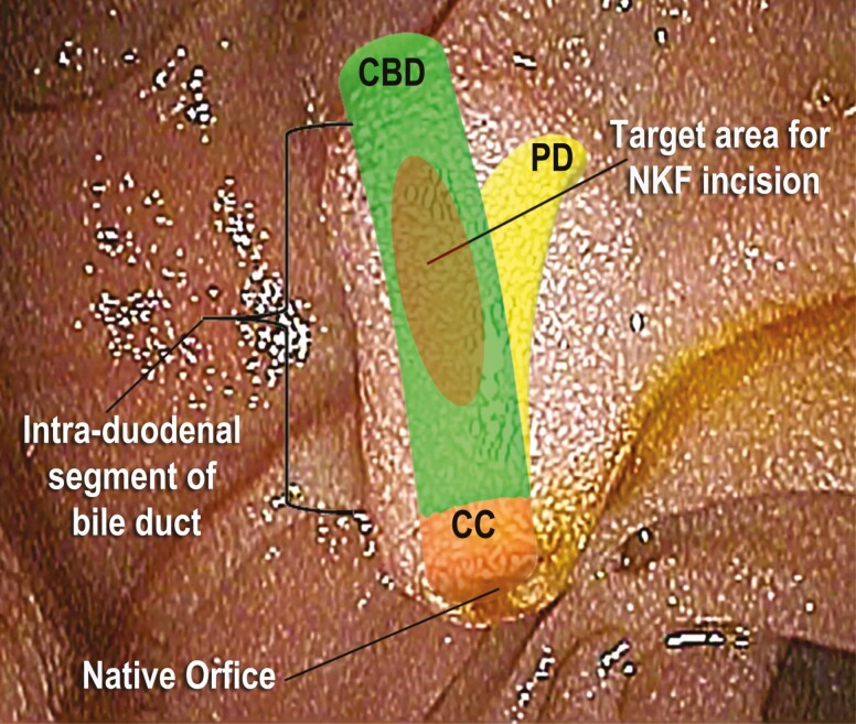 Rudimentary luminal anatomy of ampulla noting the common bile duct (CBD), pancreatic duct (PD), common channel (CC), native orifice, intra-duodenal segment of the bile duct and the target area for the needle-knife fistulotomy (NKF) incision.