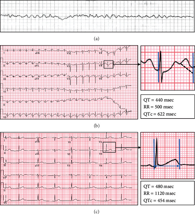 (a) Ventricular fibrillation detected by emergency medical services requiring defibrillation; (b) QTc measured in ECG obtained after correction of electrolyte abnormalities (measured by U-wave avoidance technique and calculated by the Bazett Formula: QTc=QT/RR); (c) measurement of QTc from baseline ECG done several years prior.
