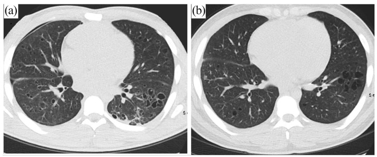 (a) CT at initial presentation. (b) Follow-up CT 4 months later showing resolution of pneumothorax, decrease in number of thin-walled cysts, and scattered small pulmonary nodules.CT: computed tomography.