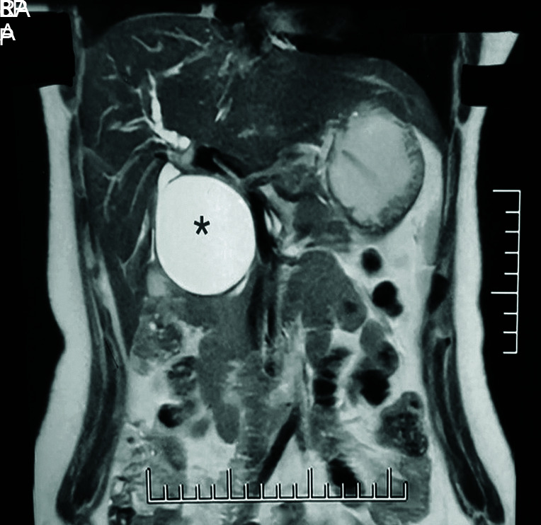 Magnetic resonance cholangiopancreatography of the patient depicting a type I CDC; (* = CDC; arrow = pancreatic duct in the distal stump of CDC)