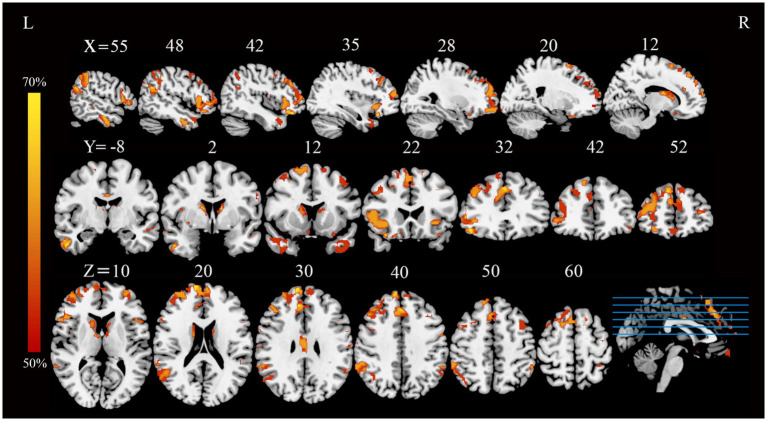 MRI brain scan images showing three views: sagittal, coronal, and axial slices, each labeled with coordinates. Orange and red highlighted areas represent regions of interest, indicating varying activity levels. A color bar on the left shows percentages from fifty to seventy percent, with yellow indicating higher activity and red indicating lower.