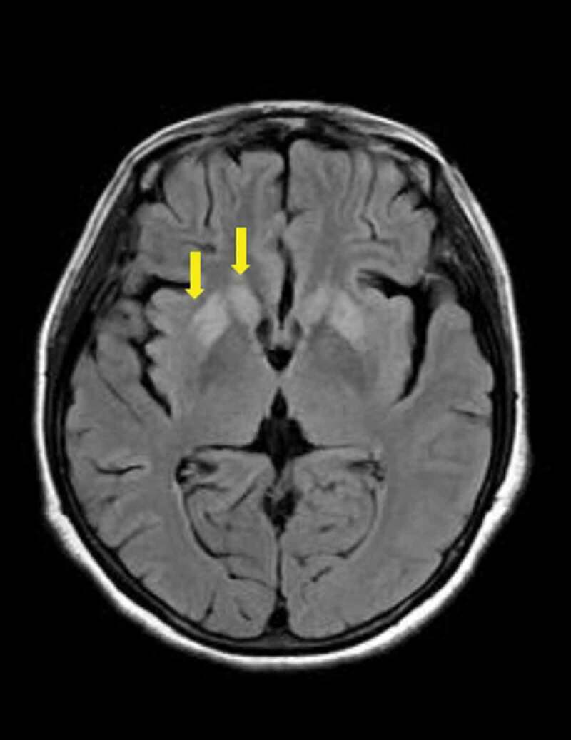 MRI with T2-FLAIR image of the patient.