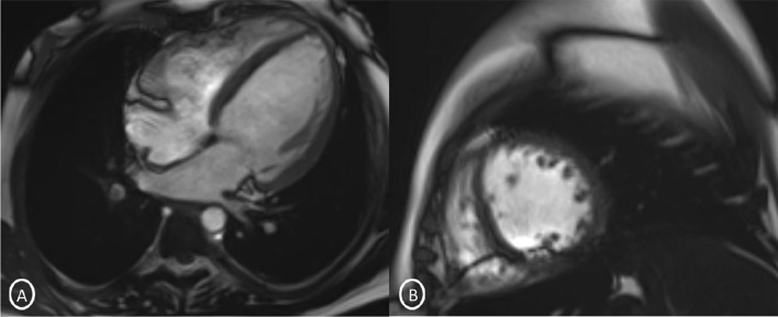 Snapshot from CINE Image T2 A Long-axis 4 chambers; B short-axis 2 chambers—showing mild global hypokinesia and left ventricle dilatation