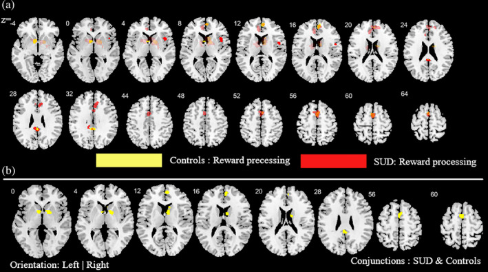 Additional analysis aimed at mapping alterations in SUD (across all substances) relative to controls as well as common activities between SUD and controls during reward‐related task paradigms. (a) Subtraction ALE comparing SUD and controls during reward task paradigms. Yellow (controls > SUD); Red (SUD > controls). (b) Conjunction ALE maps for reward‐related task paradigms between SUD and control participants. Displayed at FWE < 0.05