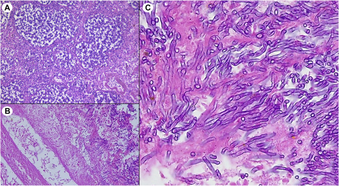 Histological lung sections from recipient’s autopsy showing (A) multiple foci of bronchopneumonia, (B) vascular erosion associated with widespread blood extravasation and, (C) well recognizable fungal branched hyphae compatible with Aspergillus spp.