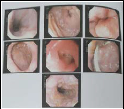 ERCP showing reflex oesophagitis LAC, stented CBD and choledocholithiasis with choledochoduodenal fistula