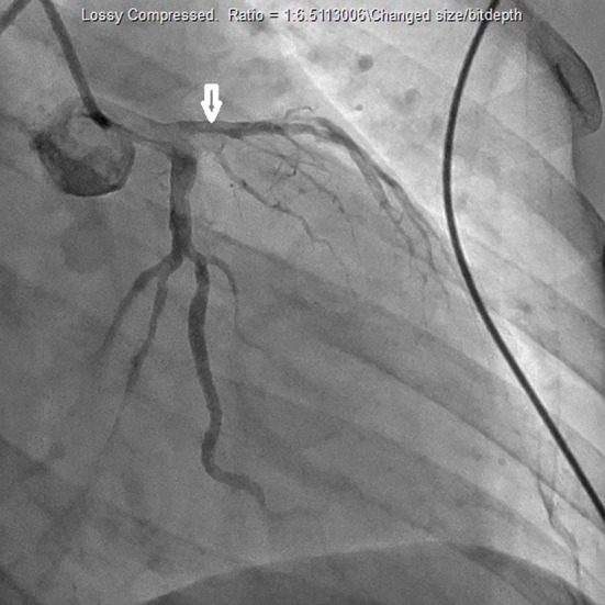 Cardiac catheterization which demonstrated blockage of the left anterior descending artery.