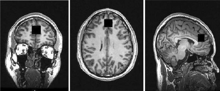 Coronal (left), axial (middle), and sagittal (right) planes depicting the placement of the voxel over the anterior cingulate during the proton magnetic resonance spectroscopy scan. The placement of the anterior cingulate voxel was based on the midline sagittal localizer with the centre of the 20 mm × 20 mm × 20 mm voxel placed 13 mm above the anterior portion of the genu of the corpus callosum, perpendicular to the anterior commissure–posterior commissure line to minimize the inclusion of white matter and cerebral spinal fluid