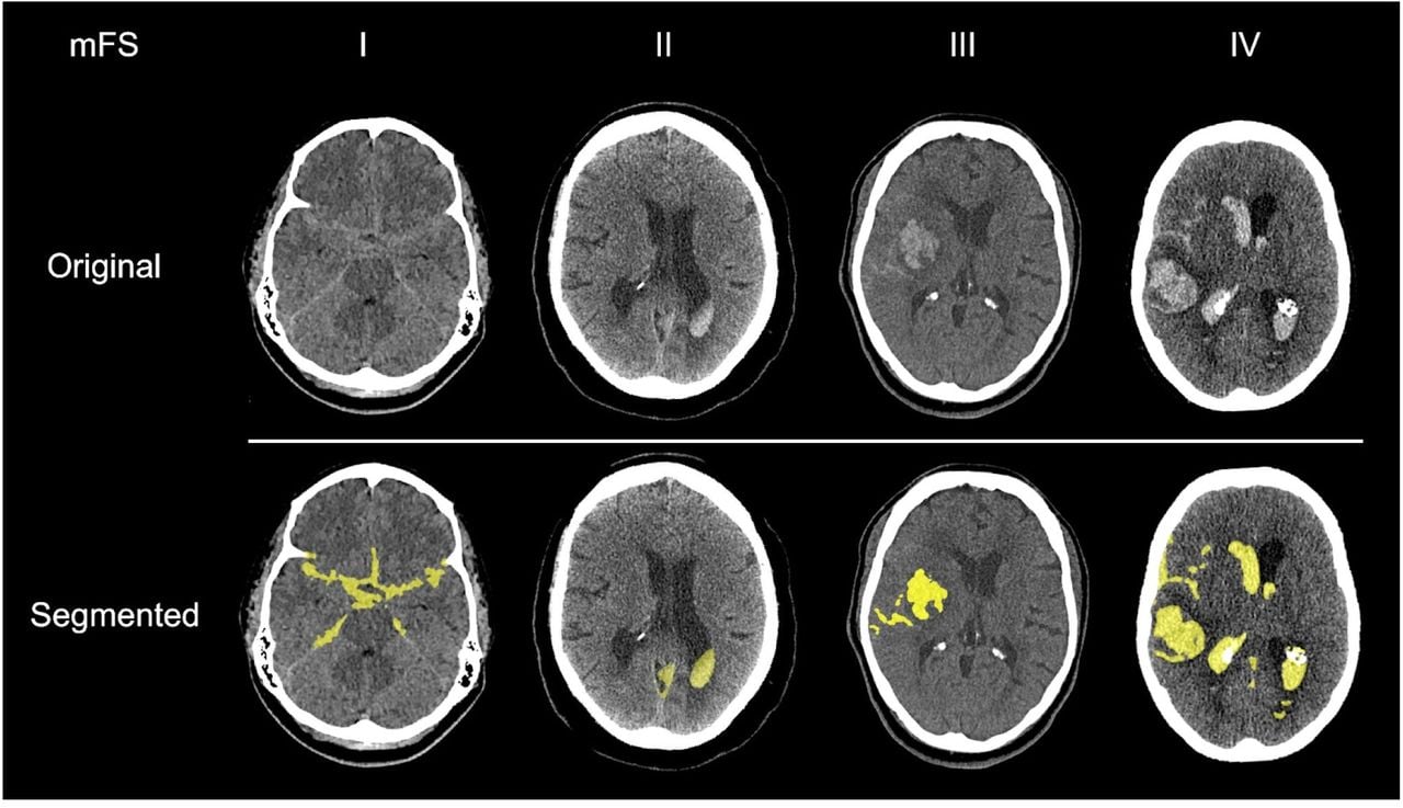 Examples of semi-automated subarachnoid haemorrhage segmentations for each modified Fisher grade.(yellow = segmentation overlay, mFS = modified Fisher Scale)