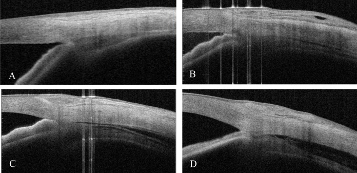 Grading of supraciliary effusion (SCE) using anterior segment optical coherence tomography. SCE was defined as a clear space between the ciliary body and sclera measured 3 mm posterior to the scleral spur on radial scans. (A)grade 0, no effusion; (B) grade 1, slit-like effusion with supraciliary space less than half the ciliary body thickness; (C) grade 2, band-like effusion with supraciliary space greater than half the ciliary body thickness; (D) grade 3, obvious effusion with supraciliary space greater than the ciliary body thickness.