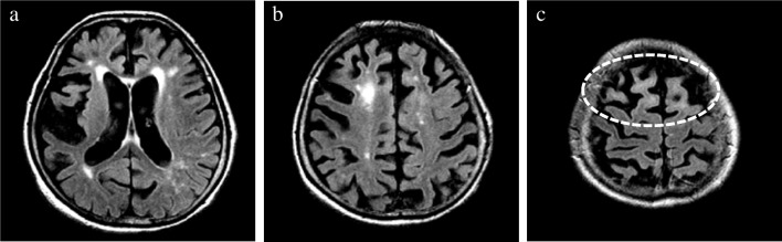 Evaluation of SWMH. The presence/absence of hyperintensity confined to the subcortical white matter (i.e., SWMH) was evaluated on an axial FLAIR image. In contrast to other lobes at lower convexity level (a, b), distinct SWMH of the bilateral frontal lobes at high convexity (c) was observed in a patient with pathologically confirmed CBD. CBD, corticobasal degeneration; SWMH, subcortical white matter hyperintensity