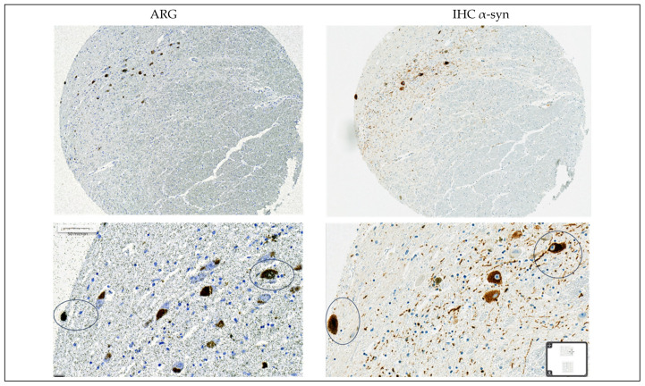 Representative high magnification images from immunohistochemistry (IHC) and emulsion autoradiography (ARG) with 25 nM [3H]GMC-058 performed on TMA sections from the substantia nigra of one case with Parkinson’s disease. The circled Lewy bodies are the same identified with ARG and IHC.