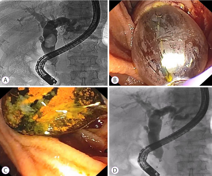 A large bile duct stone successfully treated with endoscopic papillary large balloon dilation (EPLBD). (A) Cholangiogram showing a large bile duct stone. (B) Endoscopic view of EPLBD after sphincterotomy. (C) A large stone removed with an extraction balloon. (D) Occlusion cholangiogram showing no residual filling defect.
