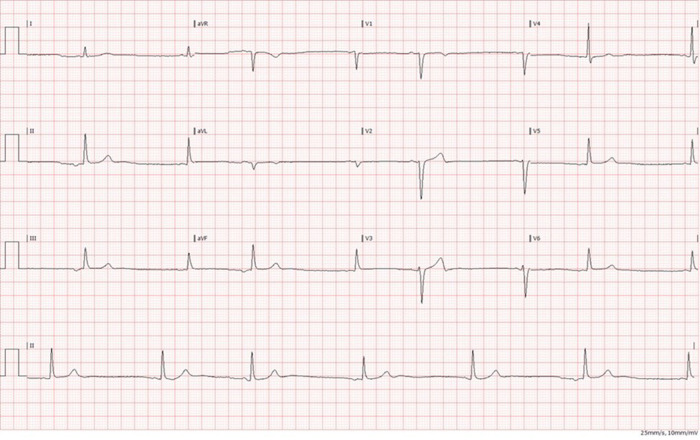 Patient 3: Retrograde sinoatrial node activation from the ectopic site.