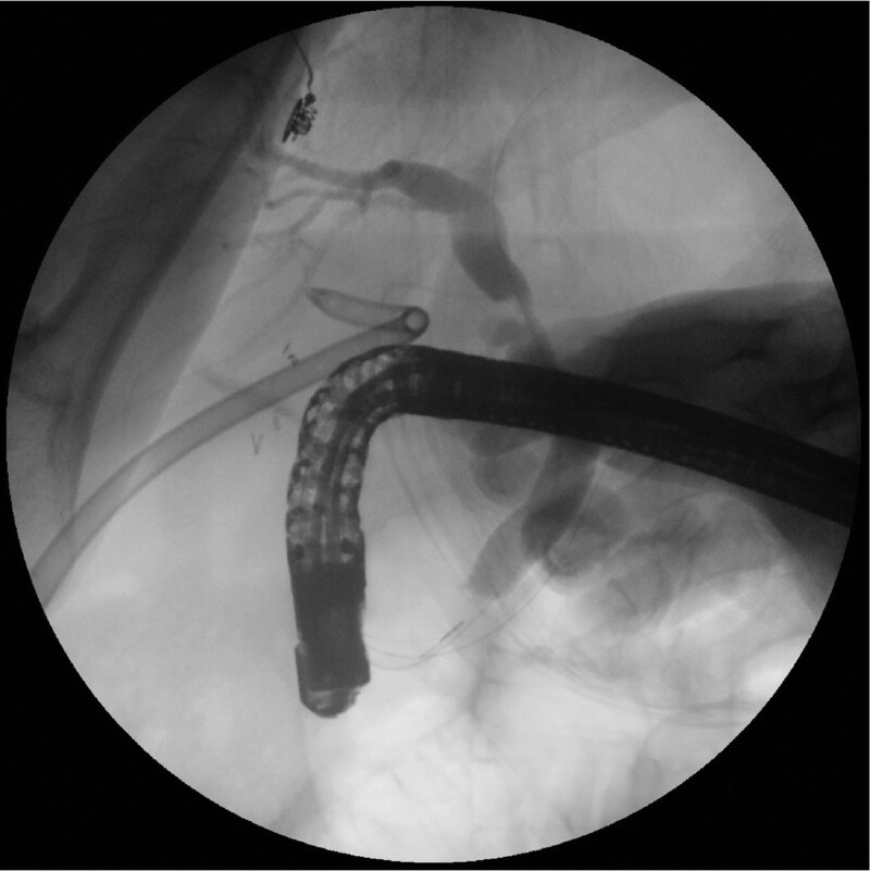 Radiographic view of conventional ERCP performed after antegrade passage of the duodenoscope through the laparoscopic port. ERCP = endoscopic retrograde cholangiopancreatography.
