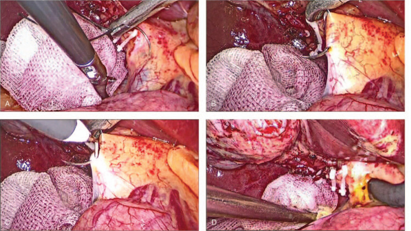 Intra-operative photographs of PDN corresponding to schematic representation in Figure 1. (A) Puncturation. (B) CBD confirmation. (C) CBD discission. (D) Exploration with a choledochoscope.