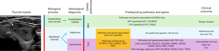 Germline genetic susceptibility to ThC and BNG.We hypothesize that two biological processes with distinct genetic architecture cause thyroid nodules: (1) hyperplasia, a polyclonal follicular cell proliferation with no malignant potential; and (2) neoplasia, a clonal growth driven by somatic genetic alterations. Neoplastic nodules can be benign or malignant, and the mismatch between biological mechanisms (hyperplasia and neoplasia) and GWAS phenotype definitions (benign and malignant thyroid nodules) has led to apparent genetic pleiotropy. The pathway and genes associated with BNG but not ThC in the GWAS meta-analysis (for example, the insulin-like growth factor 1 (IGF1) and fibroblast growth factor (FGF) signaling pathways) predispose to benign nodules. Pathways and genes associated with both BNG and ThC (for example, telomere maintenance) predispose to neoplastic thyroid nodules, either benign or malignant. In the absence of other genetic risk factors, patients develop benign adenomas or low-risk ThCs. Alternatively, genetic alterations in cell cycle and DNA damage response genes (associated predominantly with ThC but not BNG in the GWAS meta-analysis) predispose to high-risk ThC.