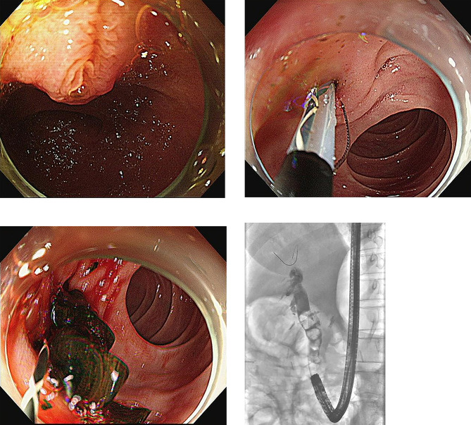 Cap-fitted forward-viewing endoscope. (A) Endoscopic view of naïve papilla (B) Endoscopic sphincterotomy with inverted sphincterotome in reverse direction (C) Removal of choledocholithiasis with balloon (D) Cholangiogram showing dilated bile duct with multiple movable filling defects