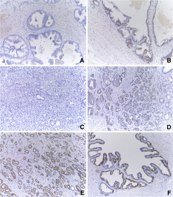 Overview of CB1R expression in prostate tissue. Prostate tissue sections were obtained after RP of four patients (original magnification ×100). In non-tumoural prostatic epithelium in general, no expression was seen (A), although some randomly distributed areas of weak positivity were noted (B). In PCa, the overall expression pattern was a mixture of negative (C) and weak positive (D) areas. Some foci of moderate positivity were randomly dispersed (E). CB1R expression in the seminal vesicles was used as an internal positive control (F).