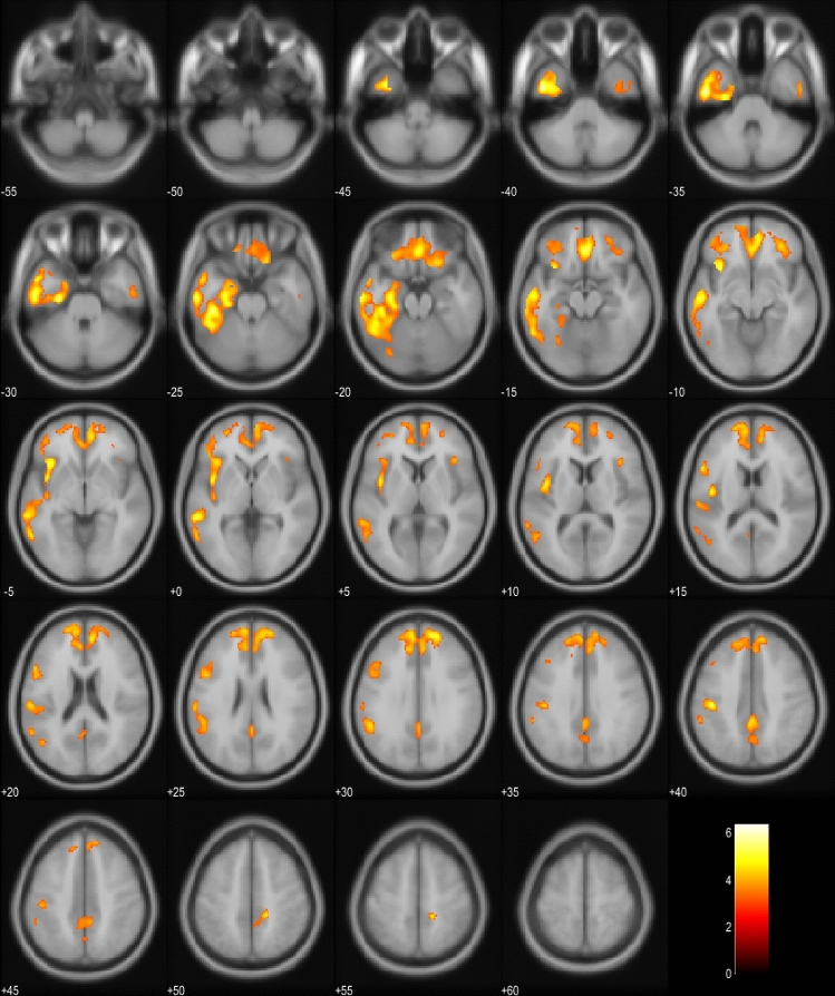 Hypometabolism in EP + patients compared to EP− patients in the whole cohort. Orange and yellow colors represent lower metabolism in the EP + group (p < 0.001, uncorrected). Images are presented in neurological orientation (i.e., left hemisphere presented in left side of the picture)