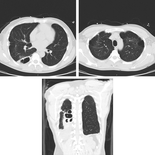 (High resolution CT Scan of chest) Diffuse emphysematous changes, bullous changes of the lateral aspect of both upper lobes, greater on the left, nonspecific mild ground glass infiltrates in the posterior aspect of the right lower lobe with adjacent bullous changes but resolution of pneumothorax. CT, computed tomography.