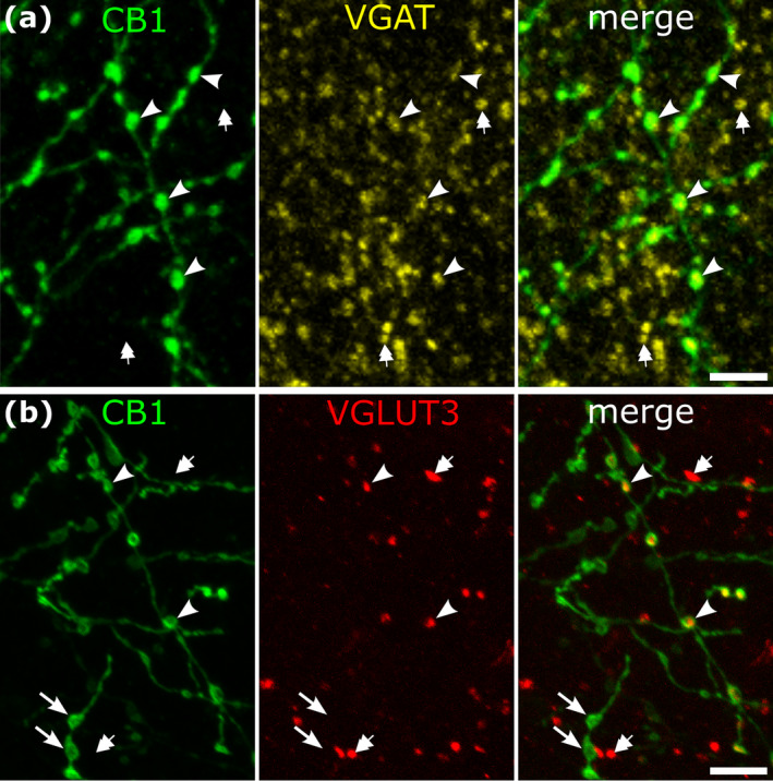 Neurotransmitter characteristics of strongly CB1‐immunoreactive axons in layers 2–3 of human neocortex. (a) Most strongly CB1‐immunoreactive boutons are VGAT‐positive, hence GABAergic (e.g. arrowheads). Many VGAT‐positive boutons are CB1‐negative (e.g. double arrows). Left medial temporal gyrus. (b) Some strongly CB1‐immunoreactive boutons are immunopositive for VGLUT3 (e.g. arrowheads), others are VGLUT3‐negative (e.g. arrows); additional boutons are VGLUT3‐positive but CB1‐negative (e.g. double arrows). Middle frontal gyrus, patient J. Immunofluorescence laser scanning images, maximum intensity projection, Z stacks of 2.4 μm (a) and 3.1 μm (b) total thickness. Scale bars: 5 μm.