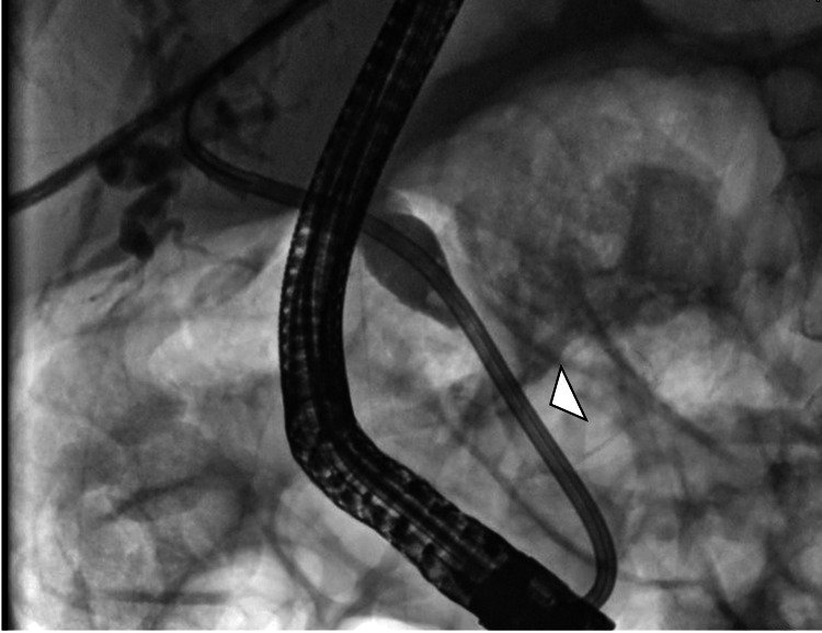 ERCP image showing biliary stent placement across the distal stricture (arrowhead)ERCP: endoscopic retrograde cholangiopancreatography