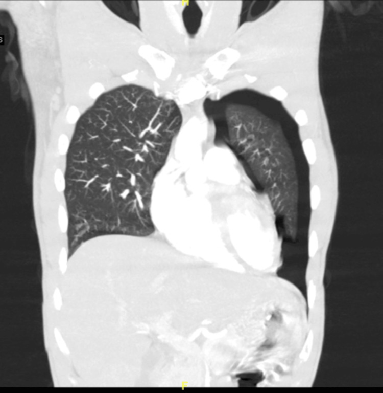 Computerized tomography with angiography of the thorax. Left-sided pneumothorax can be visualized.