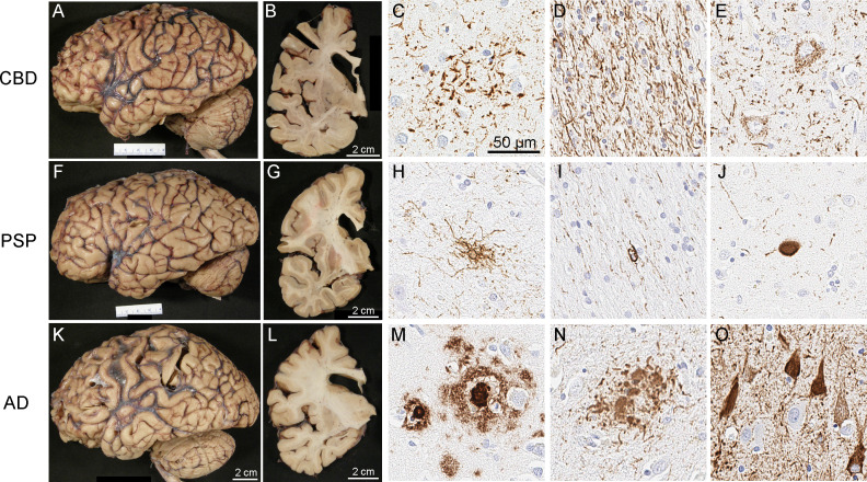 Macroscopic and microscopic findings of patients with CBS and underlying pathology of CBD (A–E), PSP (F–J), and AD (K–O). Microscopic images show immunohistochemistry for phosphorylated-tau (C–E, H–J, N–O) and amyloid-β (panel M). In CBD, the characteristic findings include astrocytic plaques (C), numerous tau-positive threads in the white matter (D) and pretangles (E). In PSP, the characteristic findings are tufted astrocytes (H), oligodendroglial coiled bodies (I), and globose neurofibrillary tangles (J). In AD, the characteristic findings with tau immunohistochemistry are neuritic plaques (N) and neurofibrillary tangles (O), as well as amyloid-β positive amyloid plaques (M). Gross patterns of brain atrophy (A, B, F, G, K, L) are not specific, but show frontal lobe atrophy and enlargement of the frontal horn of the lateral ventricle in cases with CBS. AD, Alzheimer’s disease; CBD, corticobasal degeneration; PSP, progressive supranuclear palsy.