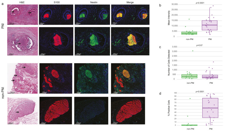 Immunohistochemistry (IHC) of Nestin. (a) Representative histology (H&E staining) images of regions selected to measure immunoreactivity of Nestin in nerves with PNI and non-PNI foci. Arrow indicates nerve fibers. IHC double immunofluorescence of morphological regions selected in H&E with Nestin and S100 staining. (b) Mean intensity of Nestin in S100-positive regions in nerve areas in PNI and non-PNI foci. (c) Number of cells detected/region. (d) Percentage of cells with positive expression of Nestin. IHC was performed in 7 PDAC samples and quantification performed in 41 regions (25 PNI and 16 non-PNI). Indicated p-values from T-test.