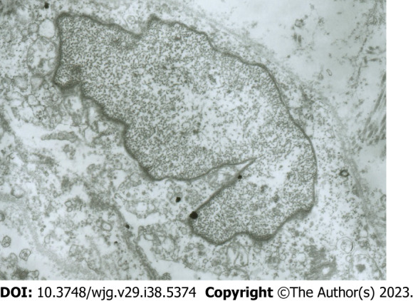 Electron microscopy images of damaged interstitial Cajal-like cells. Interstitial Cajal-like cells (ICLCs) in common bile duct notably changed after incubation with methylene blue and light treatment. The ICLCs were swollen, the cytoplasm was loose, the number of mitochondria was reduced, the caveolae disappeared, and the cell membrane was damaged.