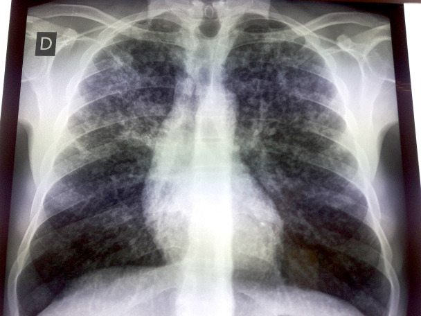 Radiographie des poumons de face, aspect de miliaire tuberculeuseFrontal chest X-ray, appearance of miliary tuberculosis