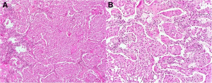Haematoxylin phyloxin saffron stain at 100× (a), and 200× (b) of surgical lung biopsy specimen showing filling of alveolar spaces by macrophages. There is mild interstitial inflammatory infiltrate