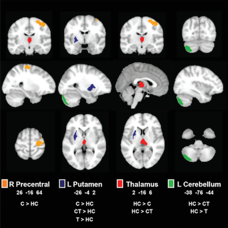 Group differences in gray matter volume. Clusters of significant volume differences (p < 0.001, famiy-wise error (FWE) cluster-corrected at p < 0.05) are displayed on representative sagittal, coronal, and axial slices overlain on the standard Montreal Neurological Institute brain. Right side of the brain is depicted on the right side. C, cannabis-dependent individual who does not smoke tobacco; CT, cannabis-dependent individual who smokes tobacco; HC, healthy control; L, left; R, right; T, cannabis-naïve, nicotine-dependent individual who smokes tobacco.