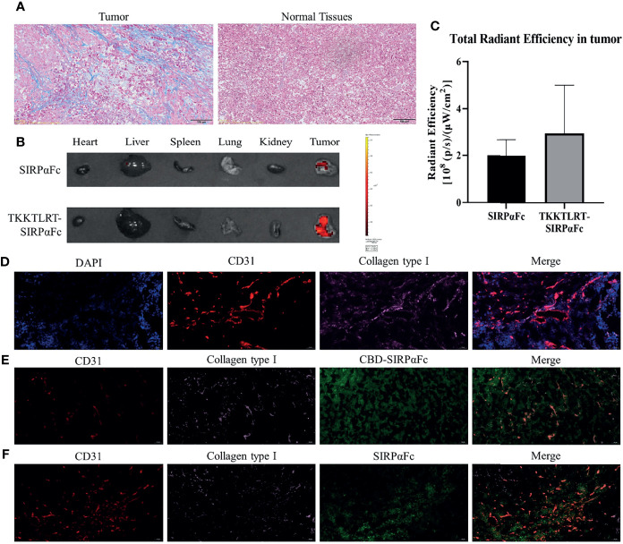 Collagen was abundant in tumors where CBD–SIRPαFc would accumulate. (A) Masson-trichrome staining showed collagenous fiber (blue) and muscle fiber (red) in tumors and paired normal tissues. Collagen was largely distributed in tumors compared to normal tissues. (B, C) FITC-labeled SIRPαFc and CBD–SIRPαFc distributed in tumor, and main organs at 2 h after intraperitoneal injection were detected, when more CBD–SIRPαFc accumulated in tumor than SIRPαFc (n = 3) (B). Total radiant efficiency in tumor was measured with Living Image software and counted with GraphPad Prism 8 software (C). (D) Immunofluorescent staining showed cell nucleus (blue), blood vessels (indicated by CD31, red), and collagen type I (pink) in tumor. Collagen was abundant and tended to be around vessels. (E, F) Immunofluorescent staining on tumors at 4 h after injection showed FITC-labeled SIRPαFc (E) or CBD–SIRPαFc (F) in tumor. Blood vessels indicated by CD31 were stained red and collagen type I was stained pink, while SIRPαFc and CBD–SIRPαFc were green. More CBD–SIRPαFc accumulated in tumor than SIRPαFc and distributed mainly around collagen.