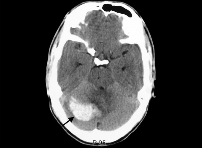 Acute intraparenchymal hemorrhage of size 41 mm × 33 mm seen in right cerebellar hemisphere